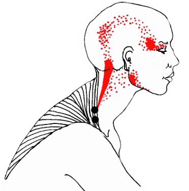 Headache diagram