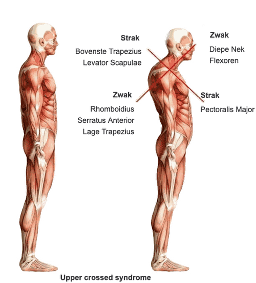Upper Crossed Syndrome